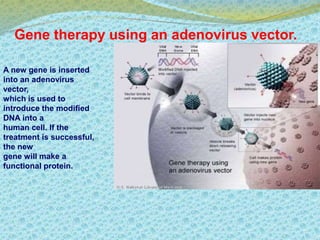 Gene therapy using an adenovirus vector. 
A new gene is inserted 
into an adenovirus 
vector, 
which is used to 
introduce the modified 
DNA into a 
human cell. If the 
treatment is successful, 
the new 
gene will make a 
functional protein. 
 