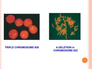 TRIPLE CHROMOSOME #20    A DELETION in
                        CHROMOSOME #22
 