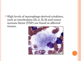    High levels of macrophage-derived cytokines,
    such as interleukins (IL-2, IL-6) and tumor
    necrosis factor (TNF) are found in affected
    tissues.
 