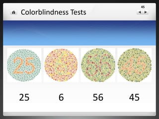 Down Syndrome • Trisomy 21
45
 