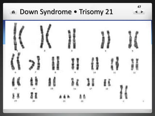 Turner Syndrome • OX
47
 