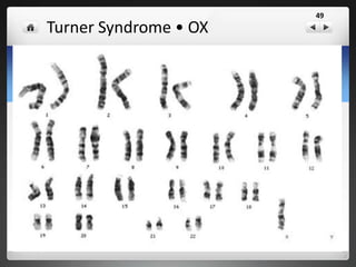 Klinefelter Syndrome • XXY
49
 