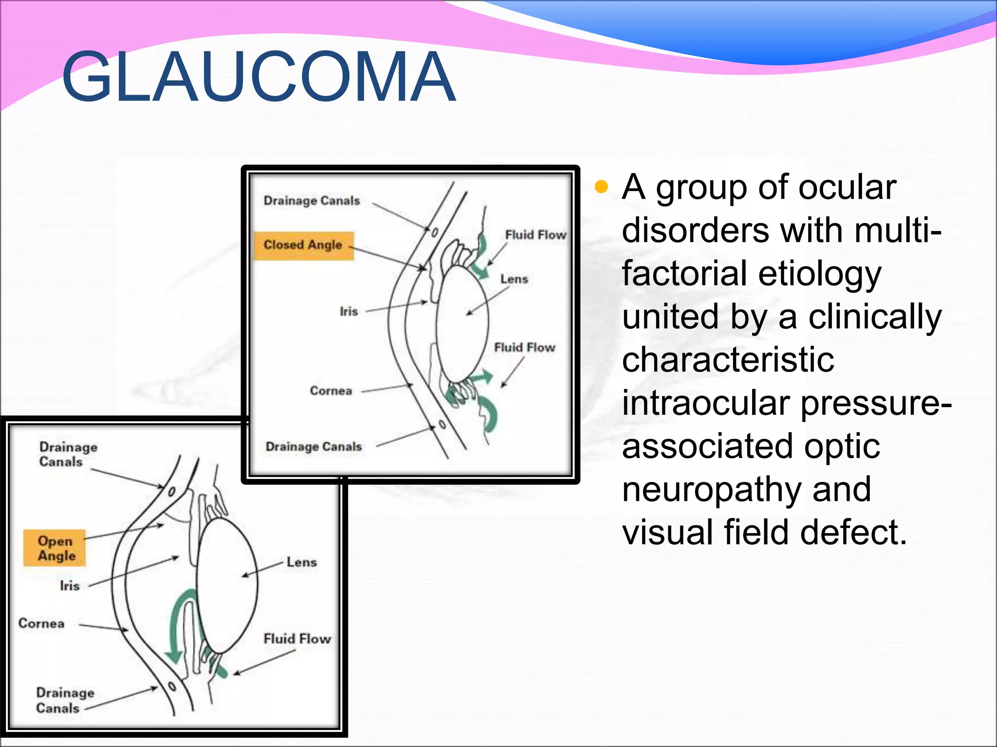 GLAUCOMA
 A group of ocular
disorders with multi-
factorial etiology
united by a clinically
characteristic
intraocular pressure-
associated optic
neuropathy and
visual field defect.
 
