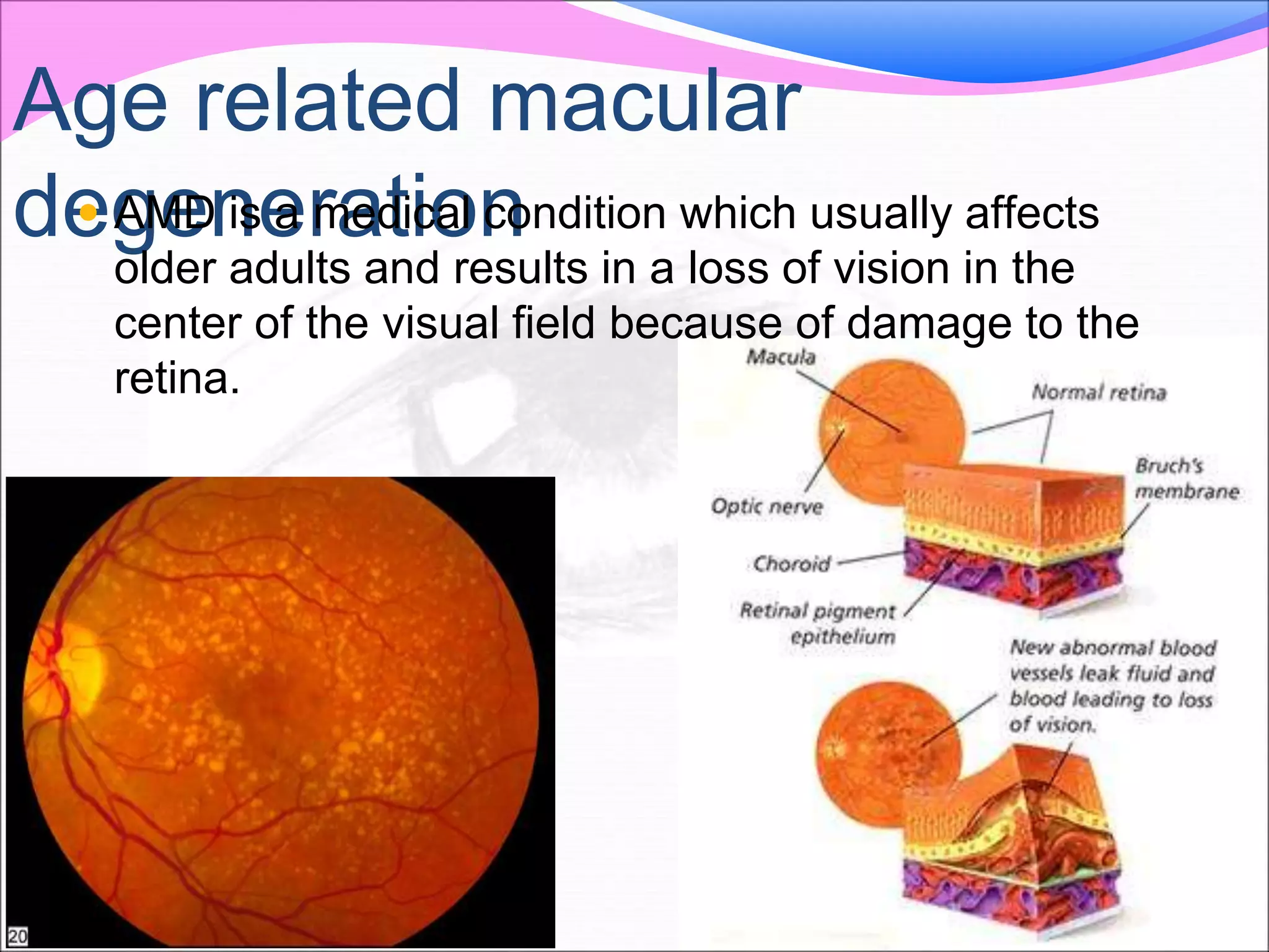 Age related macular
degeneration AMD is a medical condition which usually affects
older adults and results in a loss of vision in the
center of the visual field because of damage to the
retina.
 