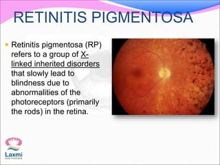 Linked Eye Rods Genetics in Ophthalmology | PPTX