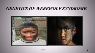 GENETICS OF WEREWOLF SYNDROME.
19/9/2017
 