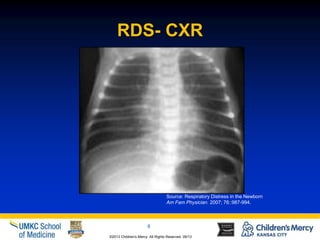Cxr In Rds Genetics of Lung Disease | PPTX