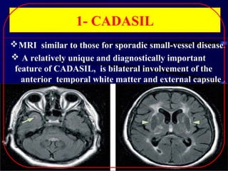 1- CADASIL
 MRI similar to those for sporadic small-vessel disease.
 A relatively unique and diagnostically important
feature of CADASIL, is bilateral involvement of the
anterior temporal white matter and external capsule .

 