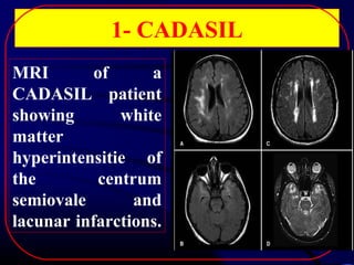1- CADASIL
MRI
of
a
CADASIL patient
showing
white
matter
hyperintensitie of
the
centrum
semiovale
and
lacunar infarctions.

 