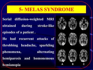 5- MELAS SYNDROME
Serial diffusion-weighted MRI
obtained

during

stroke-like

episodes of a patient .
He had recurrent attacks of
throbbing headache, sparkling
phenomena,

alternating

hemiparesis and homonemous
hemianopia

 
