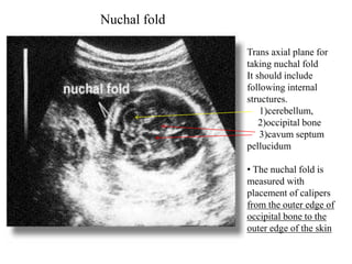 Trans axial plane for
taking nuchal fold
It should include
following internal
structures.
1)cerebellum,
2)occipital bone
3)cavum septum
pellucidum
• The nuchal fold is
measured with
placement of calipers
from the outer edge of
occipital bone to the
outer edge of the skin
Nuchal fold
 