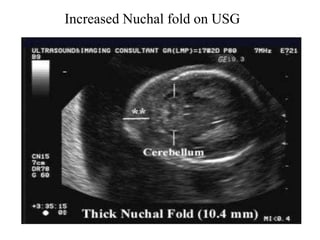 Increased Nuchal fold on USG
 