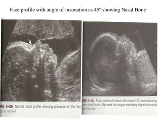 Face profile with angle of insonation as 45º showing Nasal Bone
 