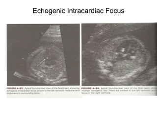 Echogenic Intracardiac Focus
 