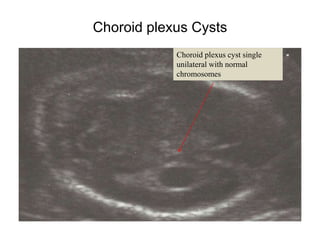 Choroid plexus Cysts
Choroid plexus cyst single
unilateral with normal
chromosomes
 