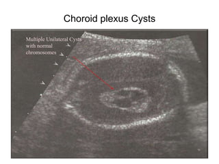 Choroid plexus Cysts
Multiple Unilateral Cysts
with normal
chromosomes
 