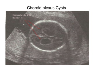 Choroid plexus Cysts
Bilateral cysts with
trisomy 18
 