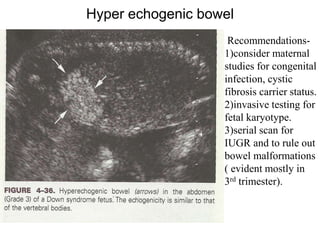 Hyper echogenic bowel
Recommendations-
1)consider maternal
studies for congenital
infection, cystic
fibrosis carrier status.
2)invasive testing for
fetal karyotype.
3)serial scan for
IUGR and to rule out
bowel malformations
( evident mostly in
3rd trimester).
 