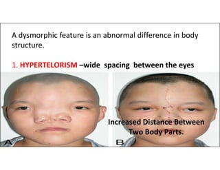 A dysmorphic feature is an abnormal difference in body
structure.
1. HYPERTELORISM –wide spacing between the eyes
Increased Distance Between
Two Body Parts.
 
