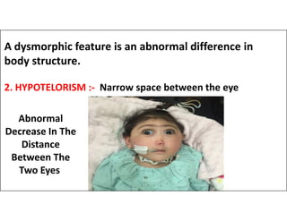 A dysmorphic feature is an abnormal difference in
body structure.
2. HYPOTELORISM :- Narrow space between the eye
Abnormal
Decrease In The
Distance
Between The
Two Eyes
 