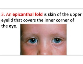 3. An epicanthal fold is skin of the upper
eyelid that covers the inner corner of
the eye.
 