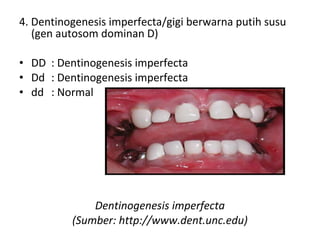 4. Dentinogenesis imperfecta/gigi berwarna putih susu 
(gen autosom dominan D)
 
• DD : Dentinogenesis imperfecta     
• Dd : Dentinogenesis imperfecta      
• dd : Normal
Dentinogenesis imperfecta
(Sumber: http://www.dent.unc.edu)
 