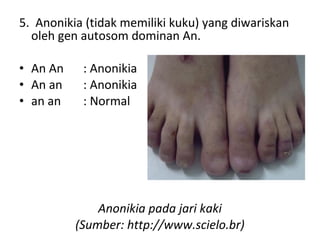 5.  Anonikia (tidak memiliki kuku) yang diwariskan 
oleh gen autosom dominan An.
 
• An An : Anonikia       
• An an : Anonikia               
• an an : Normal
Anonikia pada jari kaki
(Sumber: http://www.scielo.br)
 