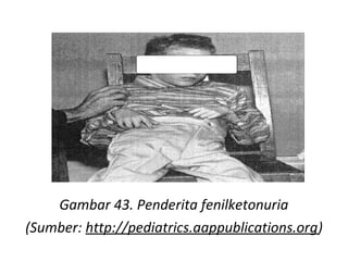 Gambar 43. Penderita fenilketonuria
(Sumber: http://pediatrics.aappublications.org)
 