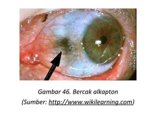 Gambar 46. Bercak alkapton
(Sumber: http://www.wikilearning.com)
 