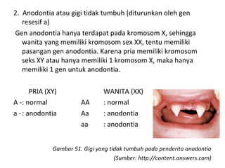 2. Anodontia atau gigi tidak tumbuh (diturunkan oleh gen
resesif a)
Gen anodontia hanya terdapat pada kromosom X, sehingga
wanita yang memiliki kromosom sex XX, tentu memiliki
pasangan gen anodontia. Karena pria memiliki kromosom
seks XY atau hanya memiliki 1 kromosom X, maka hanya
memiliki 1 gen untuk anodontia.
PRIA (XY) WANITA (XX)
A -: normal AA : normal
a -: anodontia Aa : anodontia
aa : anodontia
Gambar 51. Gigi yang tidak tumbuh pada penderita anodontia
(Sumber: http://content.answers.com)
 