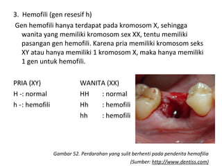 3. Hemofili (gen resesif h)
Gen hemofili hanya terdapat pada kromosom X, sehingga
wanita yang memiliki kromosom sex XX, tentu memiliki
pasangan gen hemofili. Karena pria memiliki kromosom seks
XY atau hanya memiliki 1 kromosom X, maka hanya memiliki
1 gen untuk hemofili.
PRIA (XY) WANITA (XX)
H -: normal HH : normal
h -: hemofili Hh : hemofili
hh : hemofili
Gambar 52. Perdarahan yang sulit berhenti pada penderita hemofilia
(Sumber: http://www.dentiss.com)
 