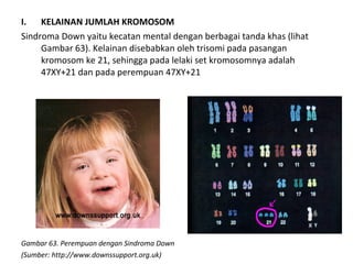 I. KELAINAN JUMLAH KROMOSOM
Sindroma Down yaitu kecatan mental dengan berbagai tanda khas (lihat
Gambar 63). Kelainan disebabkan oleh trisomi pada pasangan
kromosom ke 21, sehingga pada lelaki set kromosomnya adalah
47XY+21 dan pada perempuan 47XY+21
Gambar 63. Perempuan dengan Sindroma Down
(Sumber: http://www.downssupport.org.uk)
 