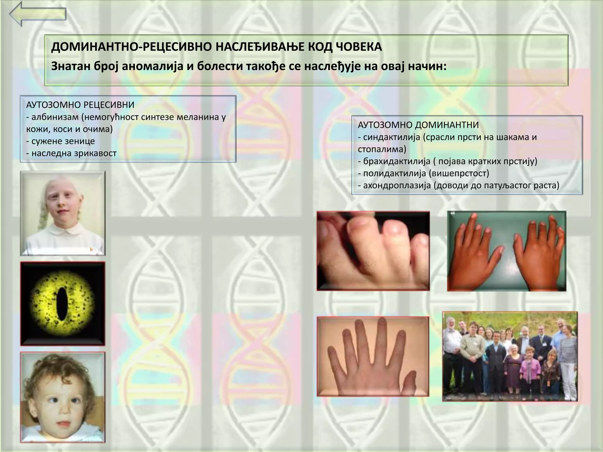 ДОМИНАНТНО-РЕЦЕСИВНО НАСЛЕЂИВАЊЕ КОД ЧОВЕКА
Знатан број аномалија и болести такође се наслеђује на овај начин:
АУТОЗОМНО РЕЦЕСИВНИ
- албинизам (немогућност синтезе меланина у
кожи, коси и очима)
- сужене зенице
- наследна зрикавост
АУТОЗОМНО ДОМИНАНТНИ
- синдактилија (срасли прсти на шакама и
стопалима)
- брахидактилија ( појава кратких прстију)
- полидактилија (вишепрстост)
- ахондроплазија (доводи до патуљастог раста)
 