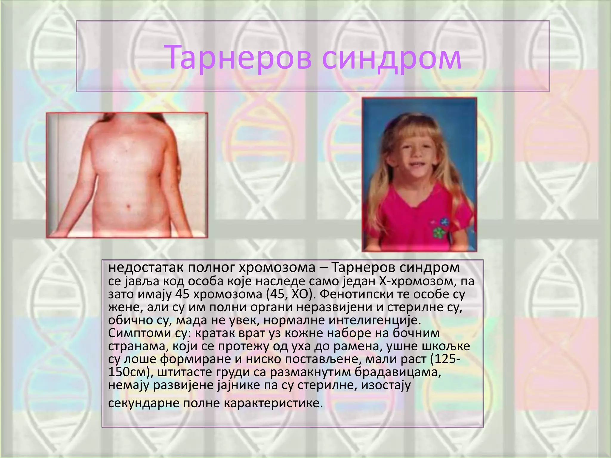 Тарнеров синдром
недостатак полног хромозома – Тарнеров синдром
се јавља код особа које наследе само један Х-хромозом, па
зато имају 45 хромозома (45, ХО). Фенотипски те особе су
жене, али су им полни органи неразвијени и стерилне су,
обично су, мада не увек, нормалне интелигенције.
Симптоми су: кратак врат уз кожне наборе на бочним
странама, који се протежу од уха до рамена, ушне шкољке
су лоше формиране и ниско постављене, мали раст (125-
150см), штитасте груди са размакнутим брадавицама,
немају развијене јајнике па су стерилне, изостају
секундарне полне карактеристике.
 