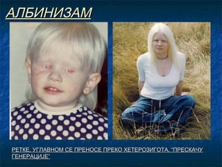 АЛБИНИЗАМ

РЕТКЕ, УГЛАВНОМ СЕ ПРЕНОСЕ ПРЕКО ХЕТЕРОЗИГОТА, “ПРЕСКАЧУ
ГЕНЕРАЦИЈЕ”

 