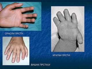 СРАСЛИ ПРСТИ

КРАТКИ ПРСТИ

ВИШАК ПРСТИЈУ

 