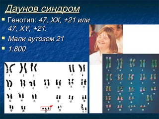 Даунов синдром





Генотип: 47, ХХ, +21 или
47, ХY, +21.
Мали аутозом 21
1:800

 