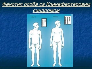 Фенотип особа са Клинефертеровим
синдромом

 