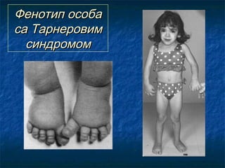 Фенотип особа
са Тарнеровим
синдромом

 