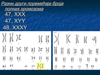 Разни други поремећаји броја
полних хромозома

47, ХХХ
47, ХYY
48, XXXY

 