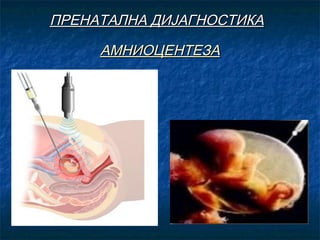 ПРЕНАТАЛНА ДИЈАГНОСТИКА
АМНИОЦЕНТЕЗА

 