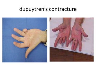 dupuytren’s contracture
 