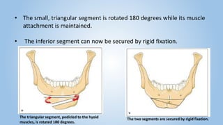 Segment Inferior Genioplasty | PPTX
