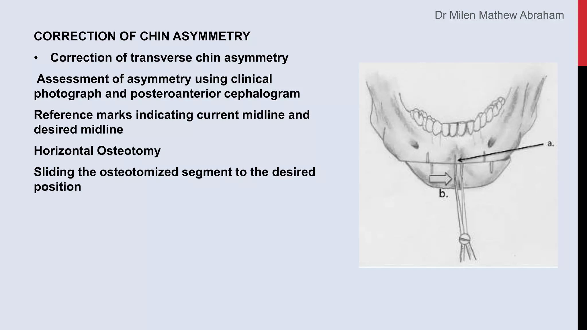 Genioplasty (1) | PPTX