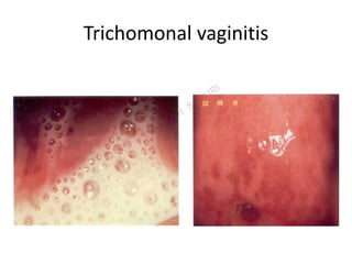 Approach to Genital discharge | PPT