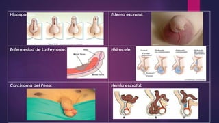Tumor testicular
Suele aparecer como un nódulo
indoloro. Todo nódulo indoloro
requiere estudio para descartar
neoplasia. C...