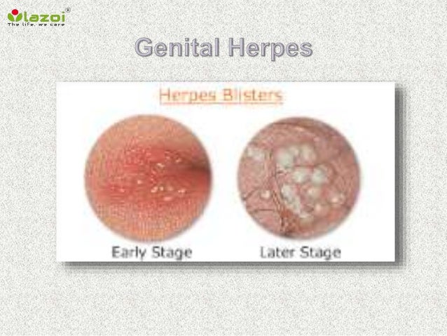 Genital herpes of Symptoms Of