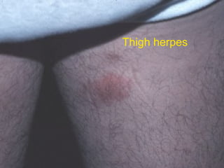 Thigh herpes 