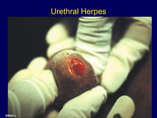 Urethral Herpes Gilbert J.  