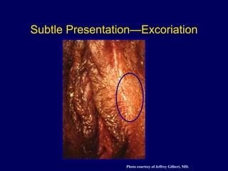 Subtle Presentation—Excoriation Photo courtesy of Jeffrey Gilbert, MD. 